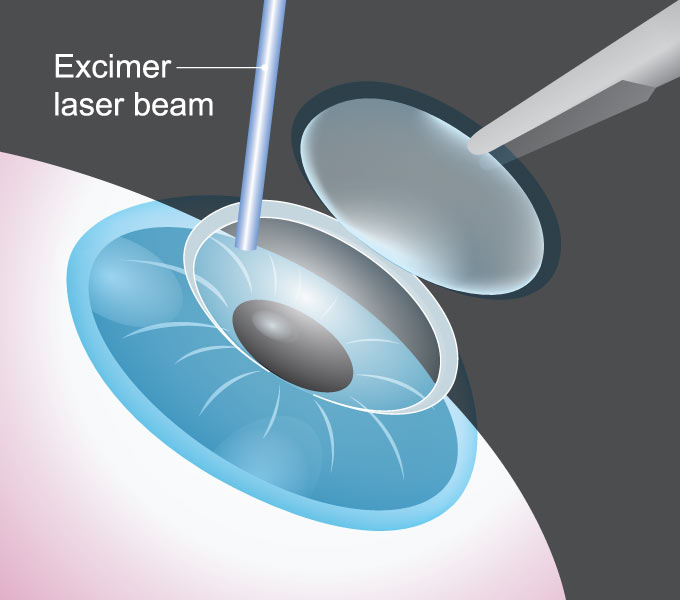 Bladeless Lasik Surgery Laser Vision Correction Massillon And North