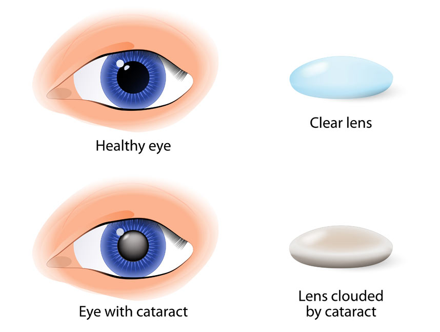 Cataracts, demonstrating how vision is affected