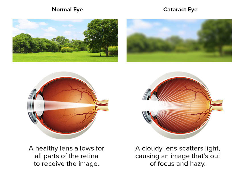 Image result for eyes cataract symptoms and operations