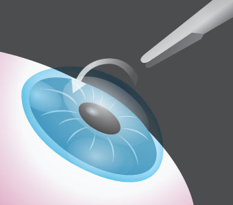 Bladeless Lasik Surgery Laser Vision Correction 